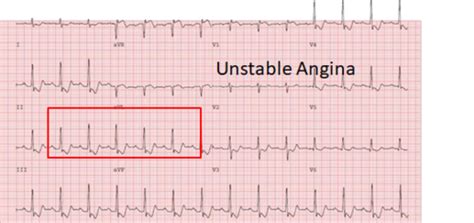 Unstable angina Flashcards | Quizlet