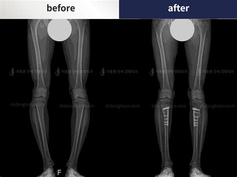 This patient corrected the leg deformity (bowlegs). This patient had ...