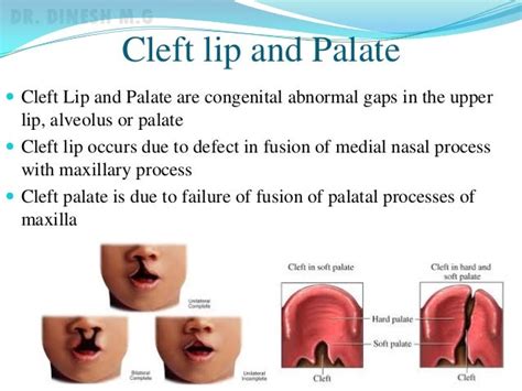 Cleft lip and palate