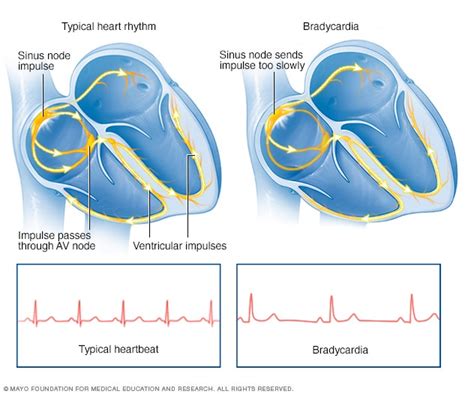 Bradycardia - Symptoms and causes - Mayo Clinic