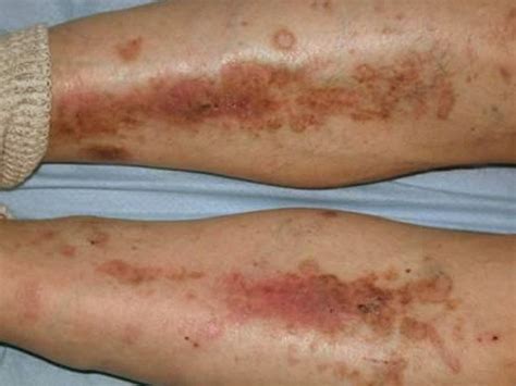 Diabetic dry skin on legs pictures 1 | Symptoms and pictures