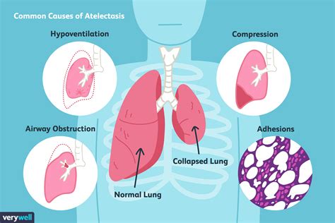 Causes and Treatment of Atelectasis (Collapsed Lung)