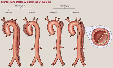 Acute type B aortic dissection - Surgery - Oxford International Edition