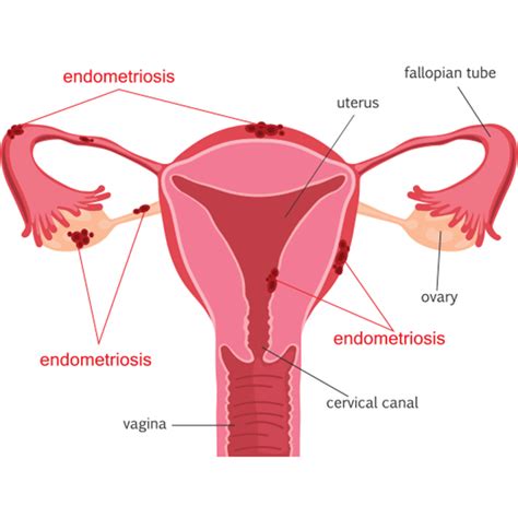 Endometriosis: Symptoms & Causes | NewYork-Presbyterian