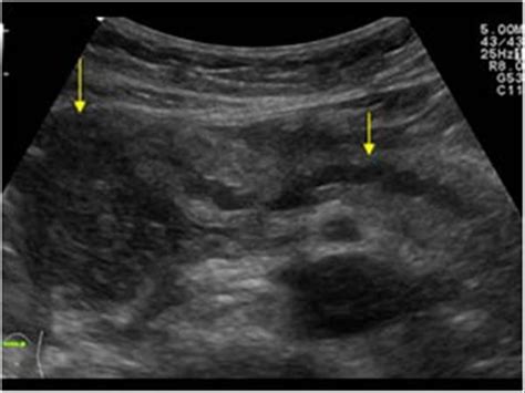 Abdomen and retroperitoneum | 1.3 Pancreas : Case 1.3.3 Metastases in ...