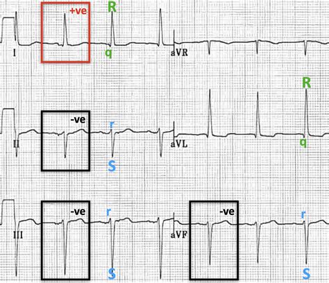 Left Anterior Fascicular Block (LAFB) • LITFL • ECG Library Diagnosis