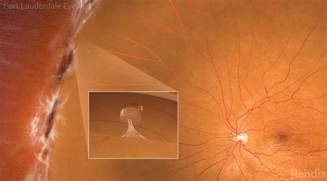 What Is Lattice Degeneration? | Fort Lauderdale Eye Institute