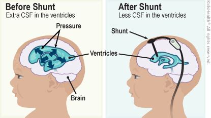 VP Shunts (for Parents) - Humana