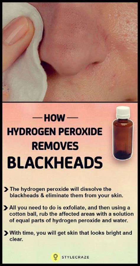 Easy Homemade Blackheads Remover with Hydrogen Peroxide - How to Get ...