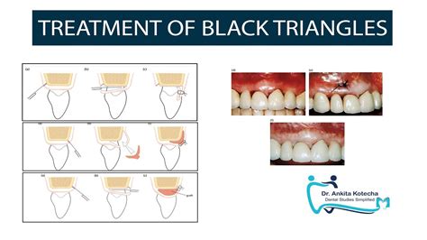 MANAGEMENT OF LOST INTERDENTAL PAPILLA|PAPILLA RECONSTRUCTION|TREATMENT ...