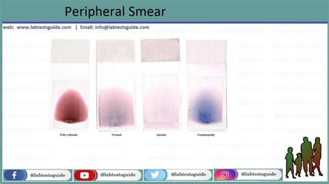 Blood Film - Lab Tests Guide