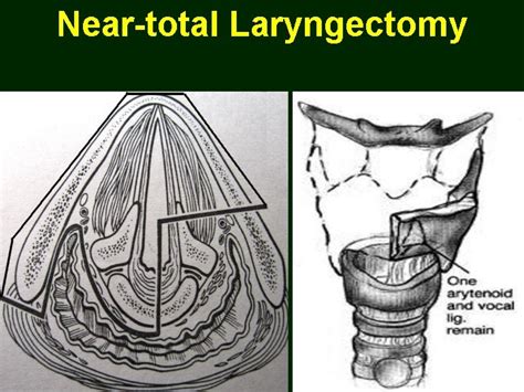 Laryngeal Malignancy Dr Vishal Sharma Overview Most common