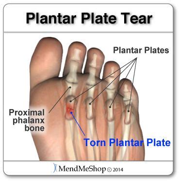 What is a Plantar Plate Tear? - Plantar Health