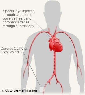 Angiogram Risks - Potential Angiography Dangers