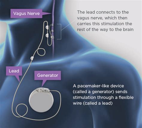 Vagus Nerve Stimulation - The Defeating Epilepsy Foundation