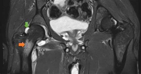 Ultimate Radiology : Septic arthritis of hip joint