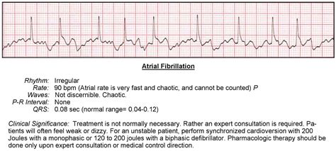 Atrial Fibrillation ECG - ACLS Wiki