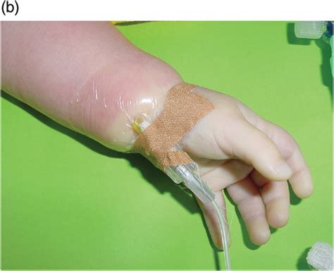 Protect Patients From IV Infiltration American Nurse, 54% OFF