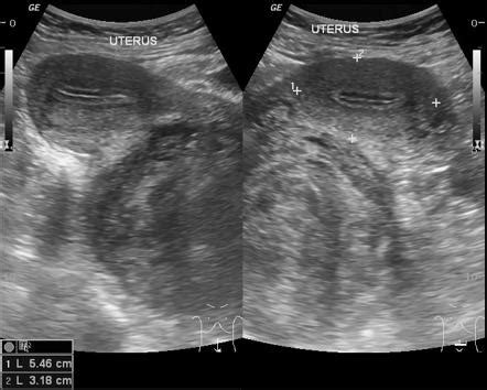 [31+] Uterine Fibroids Ultrasound Appearance