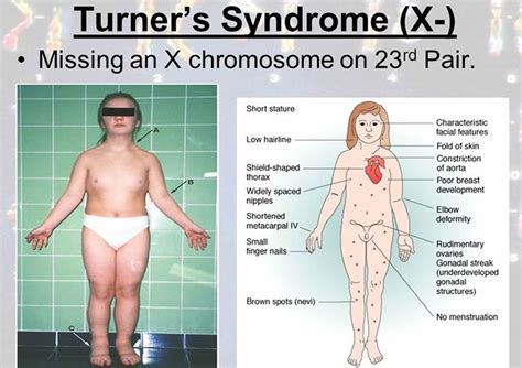 Turner Syndrome Chest