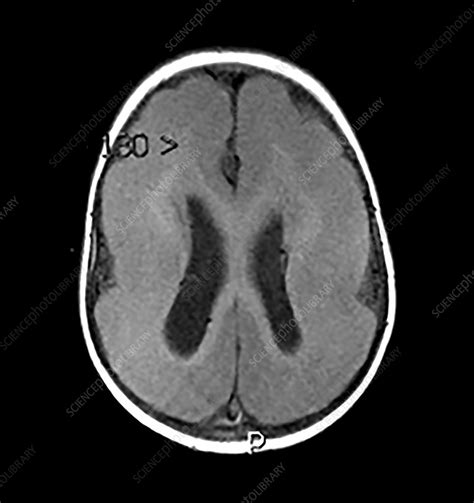 Lissencephaly - Stock Image - C043/2923 - Science Photo Library