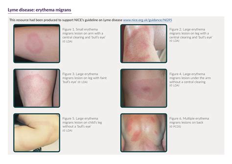 Lyme Disease UK - Lyme Disease and the EM Rash