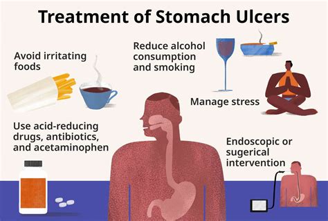 Stomach Ulcer: Types, Causes, And Symptoms, 43% OFF