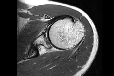 Bankart - Hill-Sachs lesions