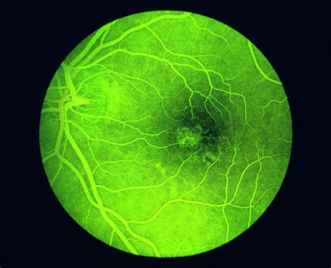 Fluorescein Angiogram Of A Healthy Eye Retina Photograph by Paul Parker ...