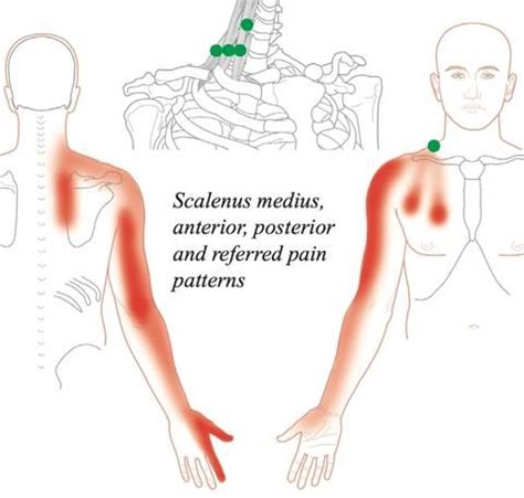 Trigger Point Therapy | Treating the Scalenes | Release Techniques ...