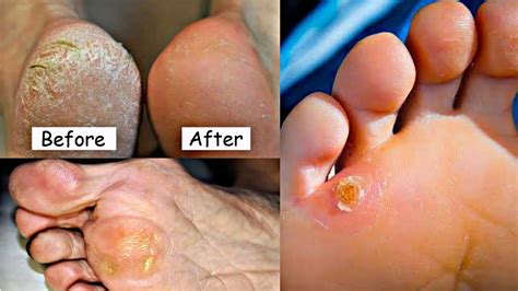 how to remove corns| foot corn treatment | foot corn removal | corns ...