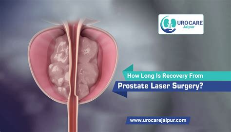 How Long Is Recovery from Prostate Laser Surgery?