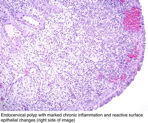 Hpv And Cervical Polyps