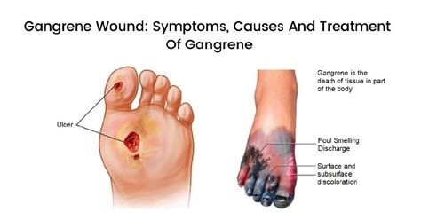 Gangreen - tipes, oorsake, simptome. Gangreenbehandelingsmetodes ...