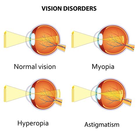 Explain the Difference Between Myopia and Hyperopia