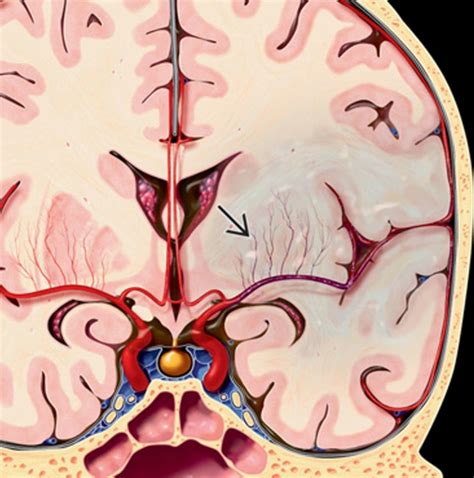 Acute Brain Ischemia/ infarction