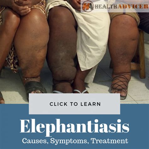 Elephantitis Elephantiasis Symptoms Treatment Pictures