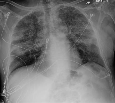 Cocaine – Crack Lung- Inhalational Pneumonitis | Lungs