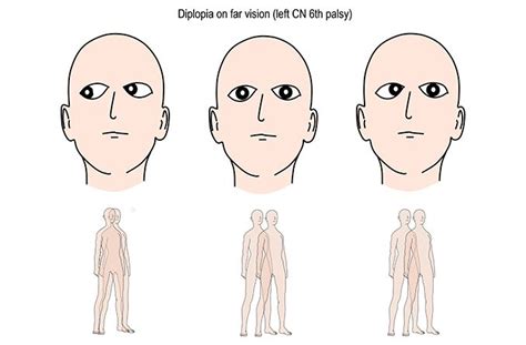 Trochlear Nerve Palsy Eye Position