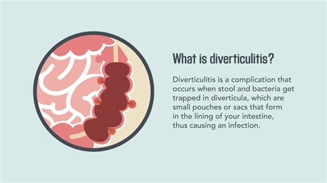 Diverticulitis: Signs, Symptoms, Causes, and Treatment | Merck Manual ...