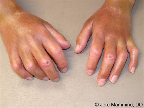 Systemic Sclerosis - American Osteopathic College of Dermatology (AOCD)