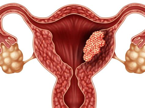 Endometrial cancer: Symptoms, staging, treatment, and causes