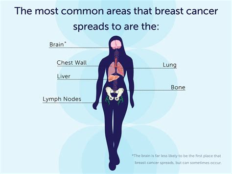 What are the Symptoms of Metastatic Breast Cancer?