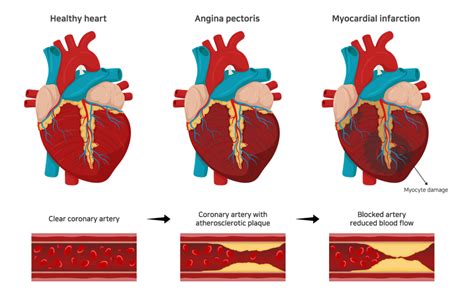 Heart Disease, Hypertension, High Blood Cholesterol - Heart Disease