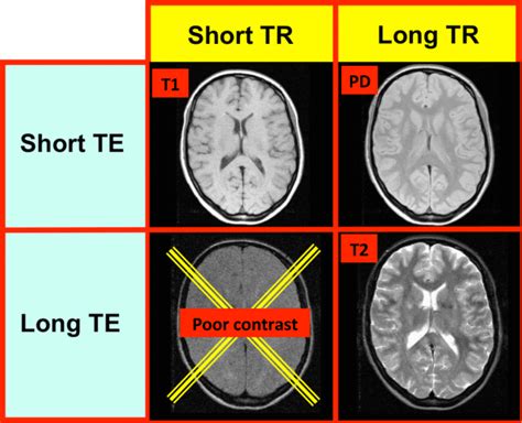 Image contrast - Questions and Answers in MRI