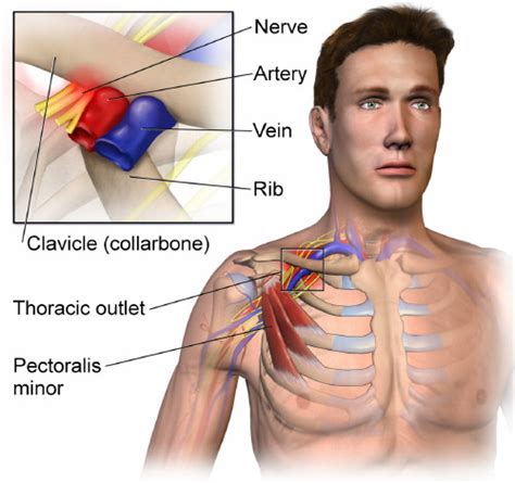 Thoracic Outlet Syndrome: Anatomy, Causes, and Treatment