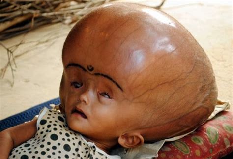 Medical Treatment Pictures-for Better Understanding: Hydrocephalus