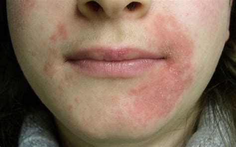 Perioral Dermatitis: Cure, Signs, Risks & Everything You Need To Know ...