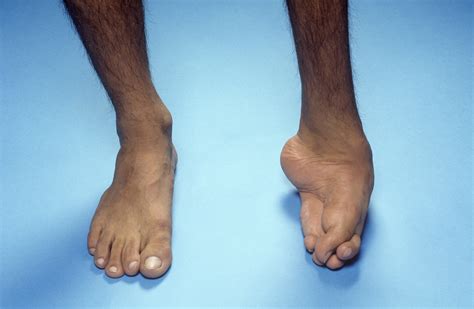 Talipes Equinovarus (Clubfoot) and Other Foot Abnormalities ...