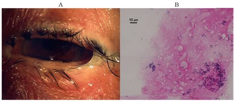 Ocular Infections Caused by Corynebacterium Species | IntechOpen